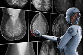 La IA podría ayudar a detectar la propagación del cáncer de mama sin necesidad de biopsia